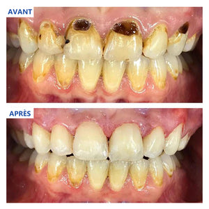 Dentifrice anti-carie pour la santé des gencives