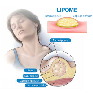 Pommade de traitement des lipomes