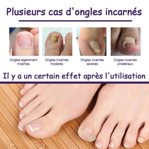 Patchs de correction des ongles