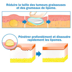Pommade de traitement des lipomes
