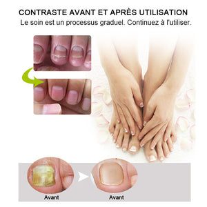 Crème de réparation des ongles mains et pieds-Achetez 1 obtenez 1 gratuitement (2 pièces)