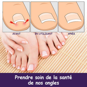 Patchs de correction des ongles